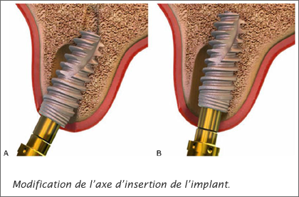 Modification de l’axe d’insertion de l’implant