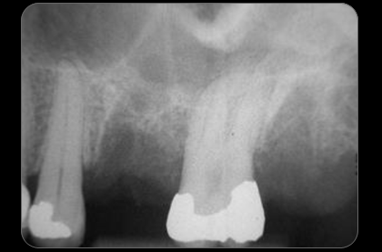 radiographie du site dentaire