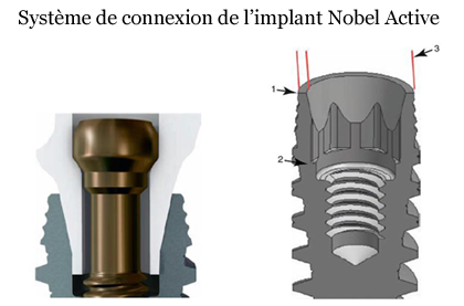 système de connexion de l'implant Nobel Active