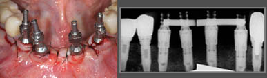 Extraction implantation immédiate