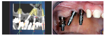 Implantologie assistée par ordinateur