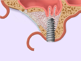 implants dentaires auto-forants