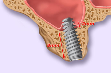 Réaction de cicatrisation autour de l’apex de l’implant