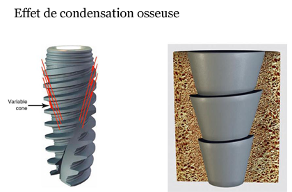 Effet de condensation osseuse de par la conception du corps de l'implant.