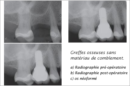 Greffes osseuses sans matériau de comblement.