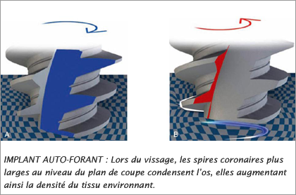 implant dentaire auto-forant