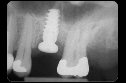 radiographie implant pose