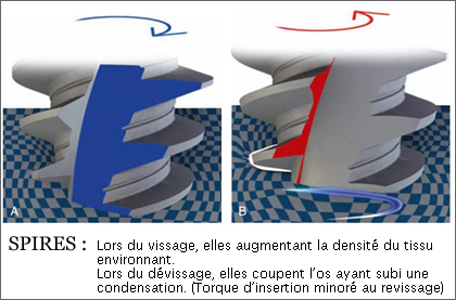 spires de l'implant dentaire