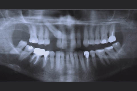 Mise en place d'un implant dentaire au travers d'une canine incluse ...